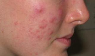 脸上长小疙瘩怎么办 脸上长小疙瘩怎么办